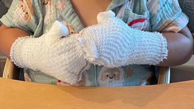 A child's hands bandaged after being burnt on playground equipment.