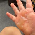 A young child's hand after being burnt on metal playground equipment.
