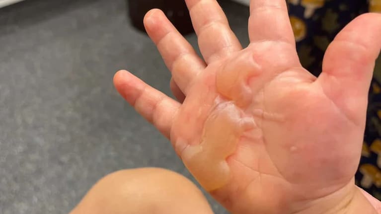 A young child's hand after being burnt on metal playground equipment.