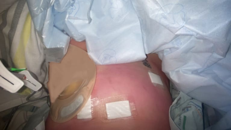 Amy Prescott's stomach post surgery.