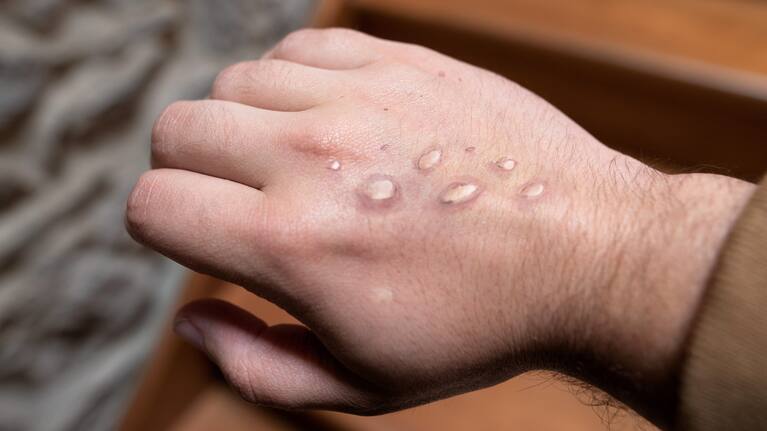 Monkeypox vesicles on a hand (file image).
