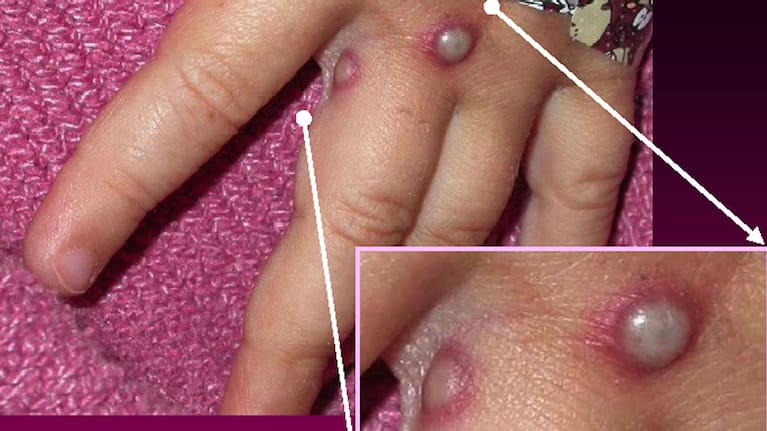 A Centers for Disease Control and Prevention handout shows mpox lesions
