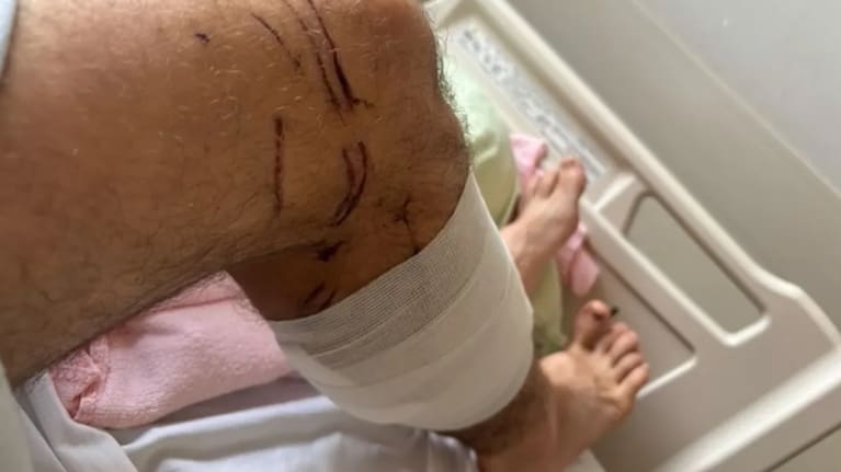 The wounds on Billy Halloran's leg after the attack. Photo: Supplied