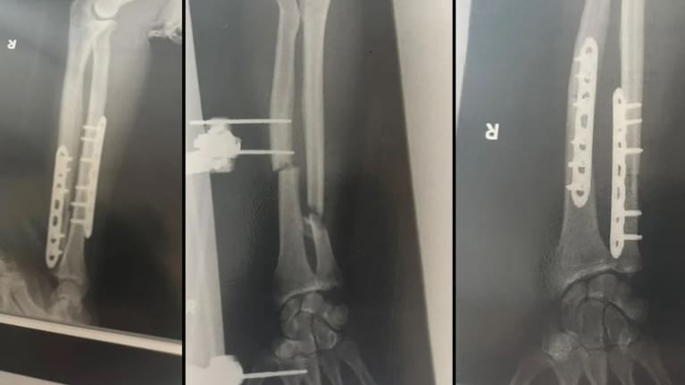 X-rays showing the repair work on Billy Halloran's arm. Photo: Supplied